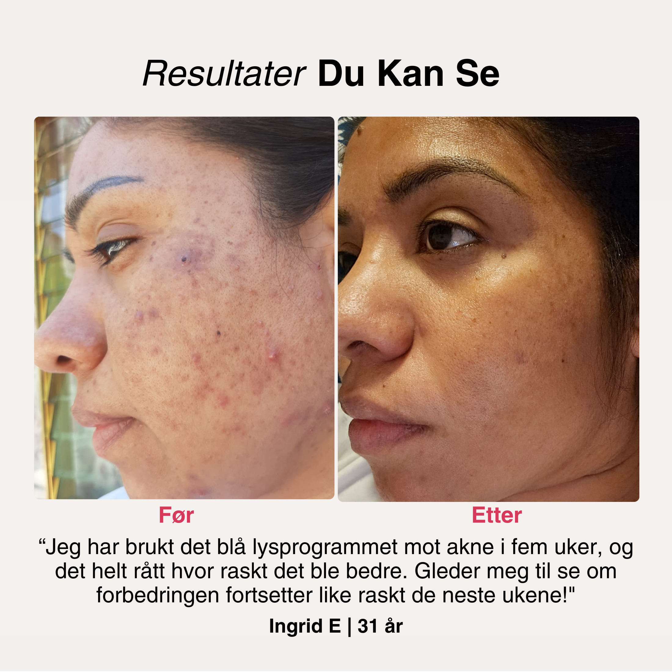 SoftSkin InfraLight® | Ansikt, Hals & Bryst