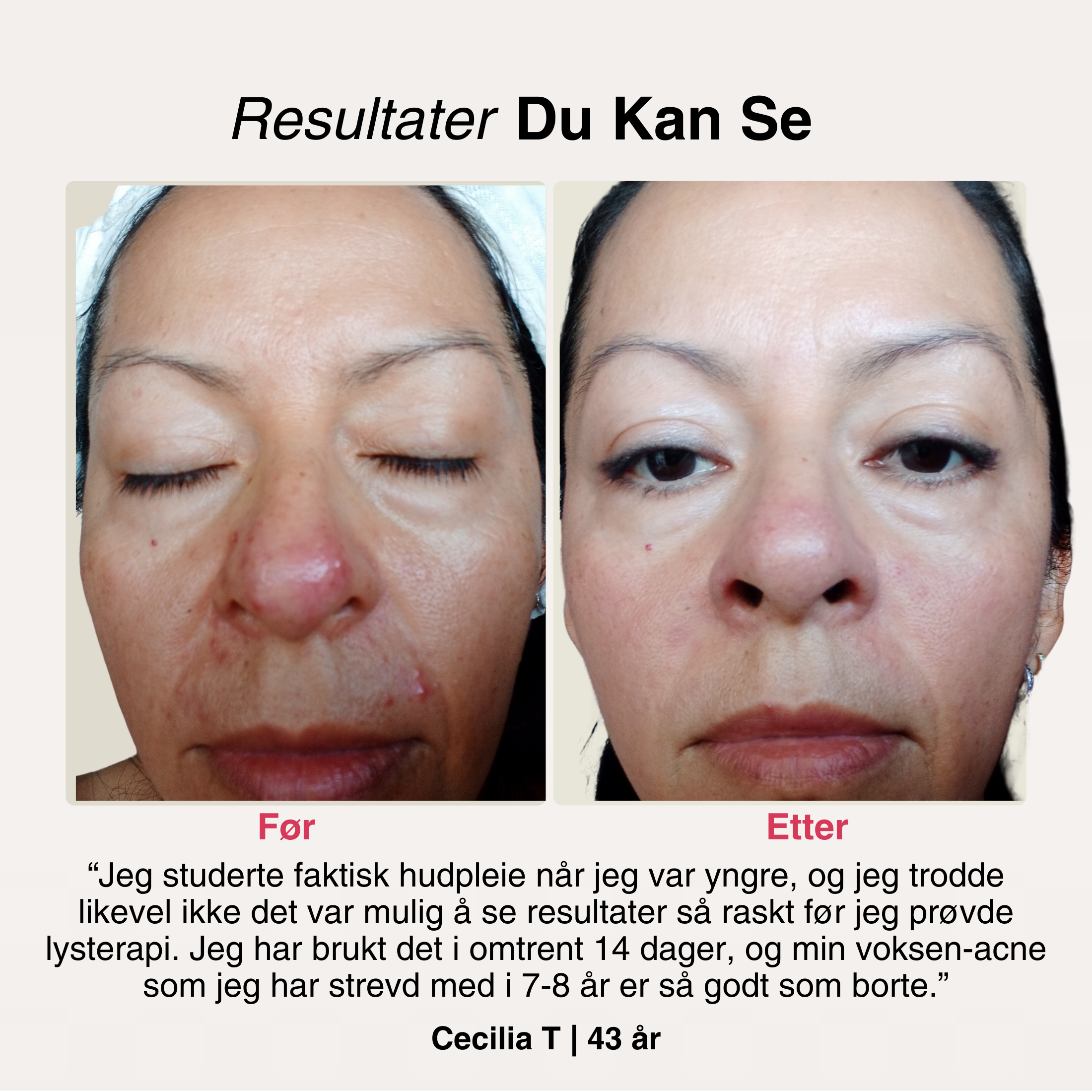 SoftSkin InfraLight® | Ansikt, Hals & Bryst