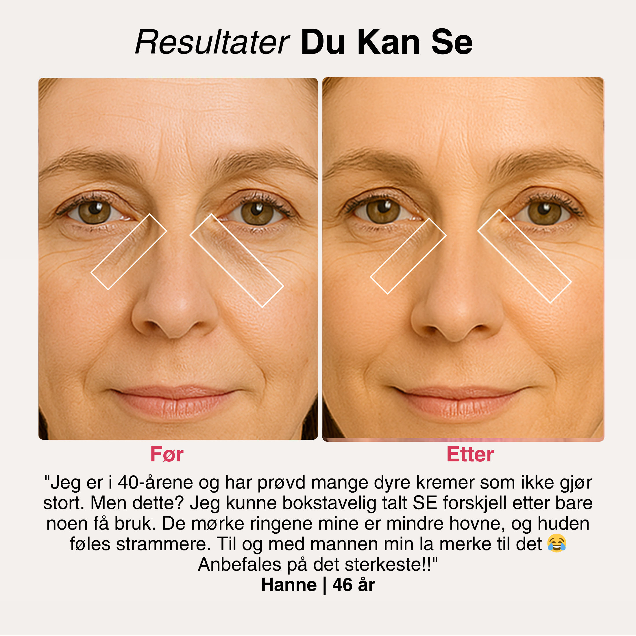 Lumi Eyes®  Rødlysbriller mot poser under øynene