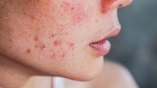 Er LED-masker trygge for sensitiv hud?