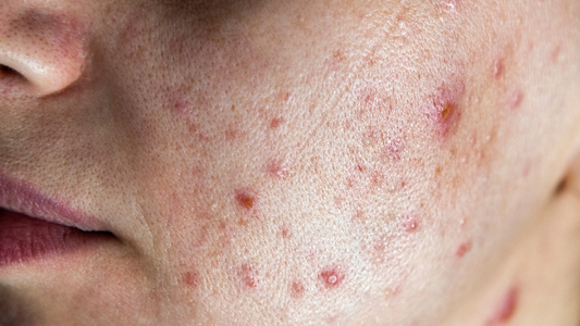 SoftSkin InfraLight® mot akne: Blått og rødt lys i kombinasjon